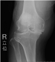 術前の変形性膝関節症
