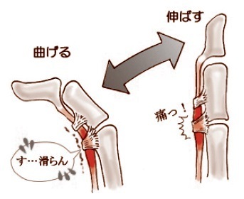 指の曲げ伸ばし時の「腱」を表した図
